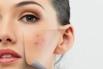 7 مجموعات أطعمة فعّالة جداً في محاربة حب الشباب .. تعرفي عليها